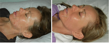 Acupuncture Face Lift Treatment
