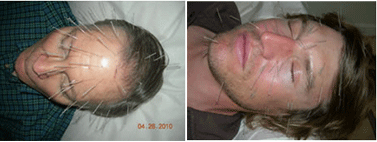 Acupuncture Face Lift Treatment