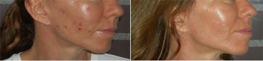 Acupuncture Face Lift Treatment